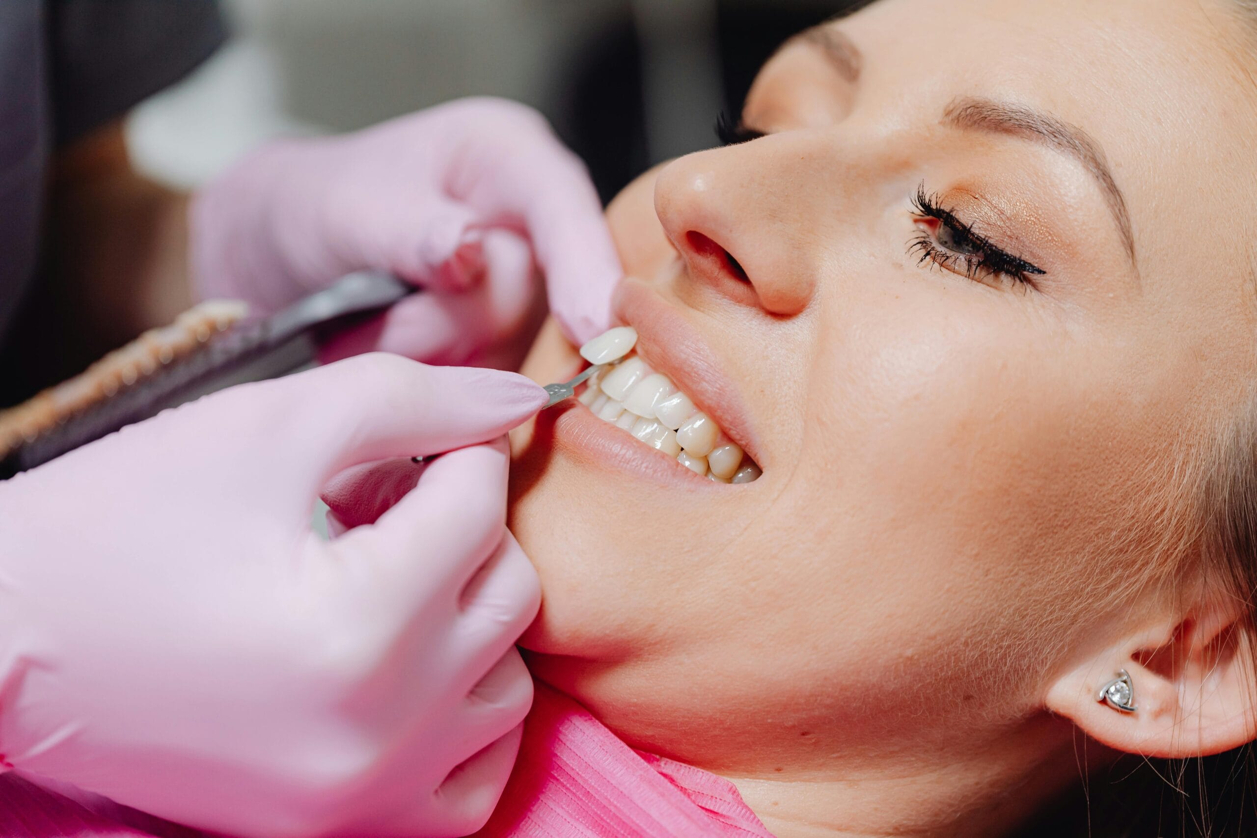 Dentist applying porcelain veneer to patient tooth Mexico dental clinic